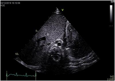 Subcostal Echocardiographic Imaging in Neonatal and Pediatric Intensive Care